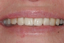 tooth corrected from decay