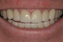teeth corrected with veneers