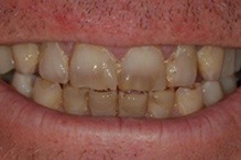 miscolored teeth