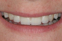woman patient after teeth whitening