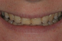 woman patient before teeth whitening