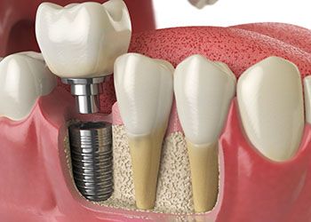 a digital illustration of the osseointegration process