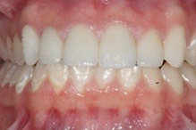 decayed teeth correct with implants