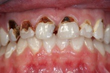 extremely decayed teeth