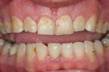teeth with plaque