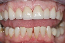 implant color correction