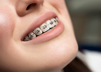 Closeup of patient with traditional braces smiling