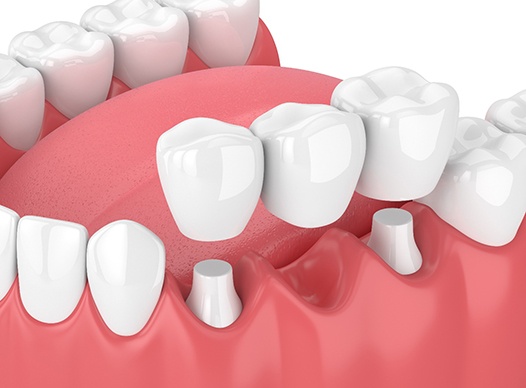 Model of a dental bridge and crowns. 