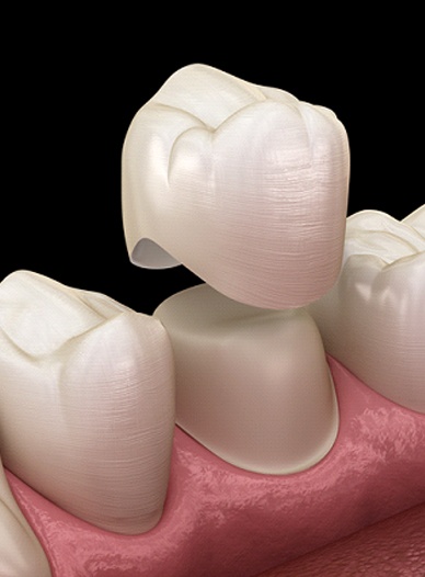 Two white dental crowns on a black background