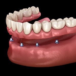 Digital model of an implant retained denture