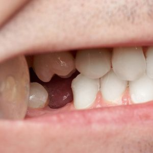 a closeup of a mouth with a missing tooth