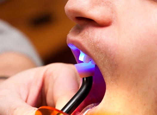 close up of man getting direct bonding hardened with curing light 