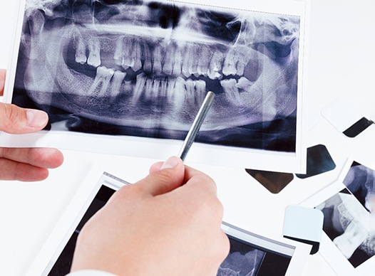 Dentist showing X-ray after tooth extraction in Moses Lake