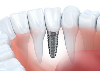 3D illustration of a dental implant and crown