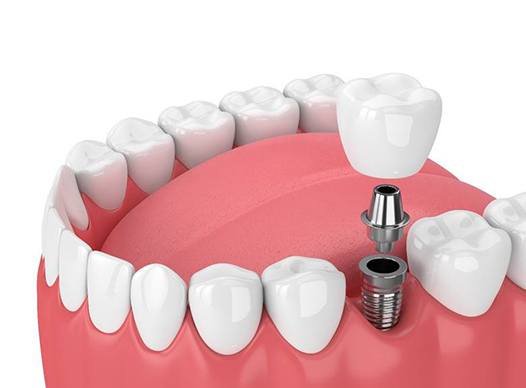 dental implant with abutment and crown in the lower jaw