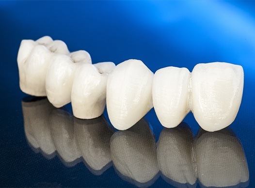 computer illustration of dental bridge