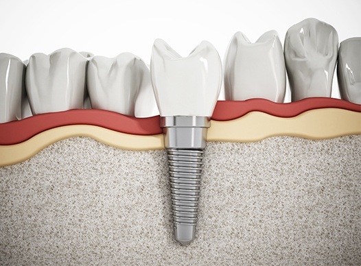 computer illustration of dental implants