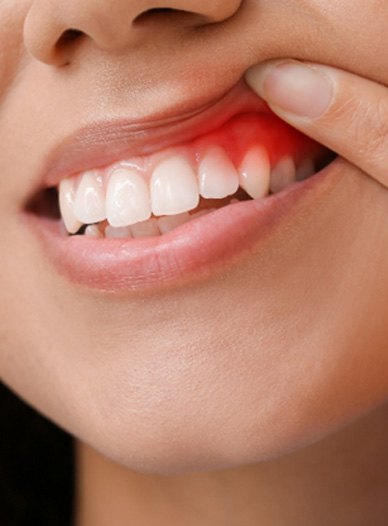 Woman pulling up lip to show signs of gum disease in Moses Lake, WA 