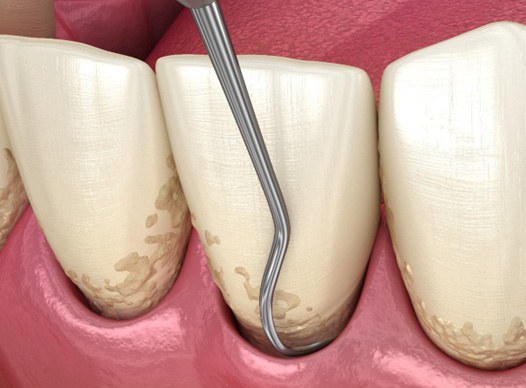 Scaling and root planing as part of gum disease treatment in Moses Lake, WA
