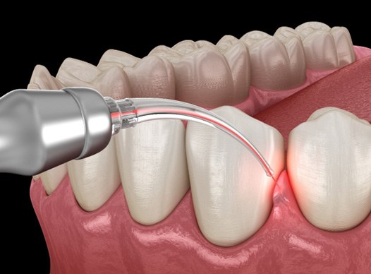 Soft tissue laser for gum disease treatment in Moses Lake, WA
