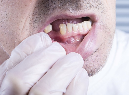 Man missing a tooth having a consultation.