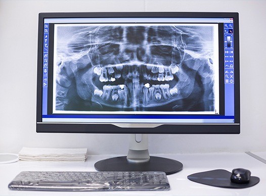 digital x-ray on computer screen