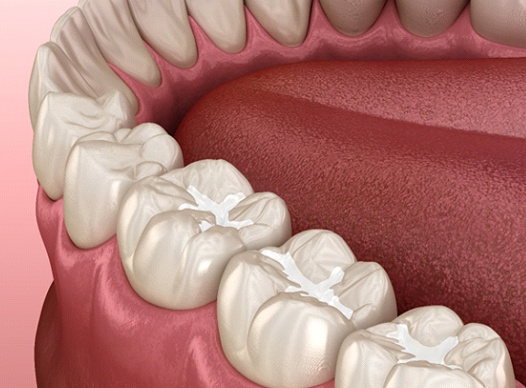 Digital illustration of tooth-colored fillings in Moses Lake