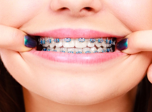 Patient showing their braces in Moses Lake