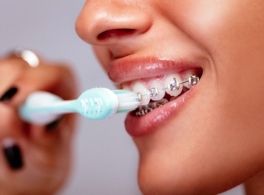 Closeup of patient brushing their braces in Moses Lake