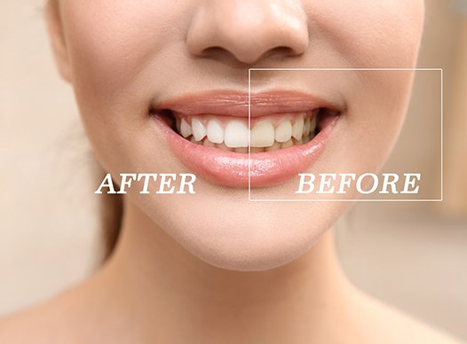 Closeup of patient's smile before and after teeth whitening