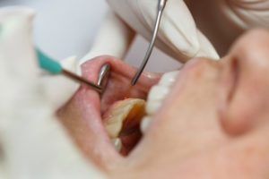 cosmetic dentist in Moses Lake using a soft tissue laser to remove gum tissue