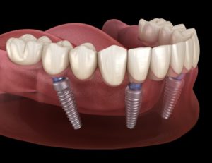 dentures on bottom arch held in place by dental implants in Moses Lake 