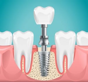 Illustration of a dental implant replacing a missing tooth.